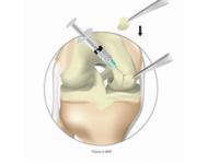 ChondroCelect; image from Tigenix